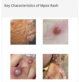 examples-of-mpox